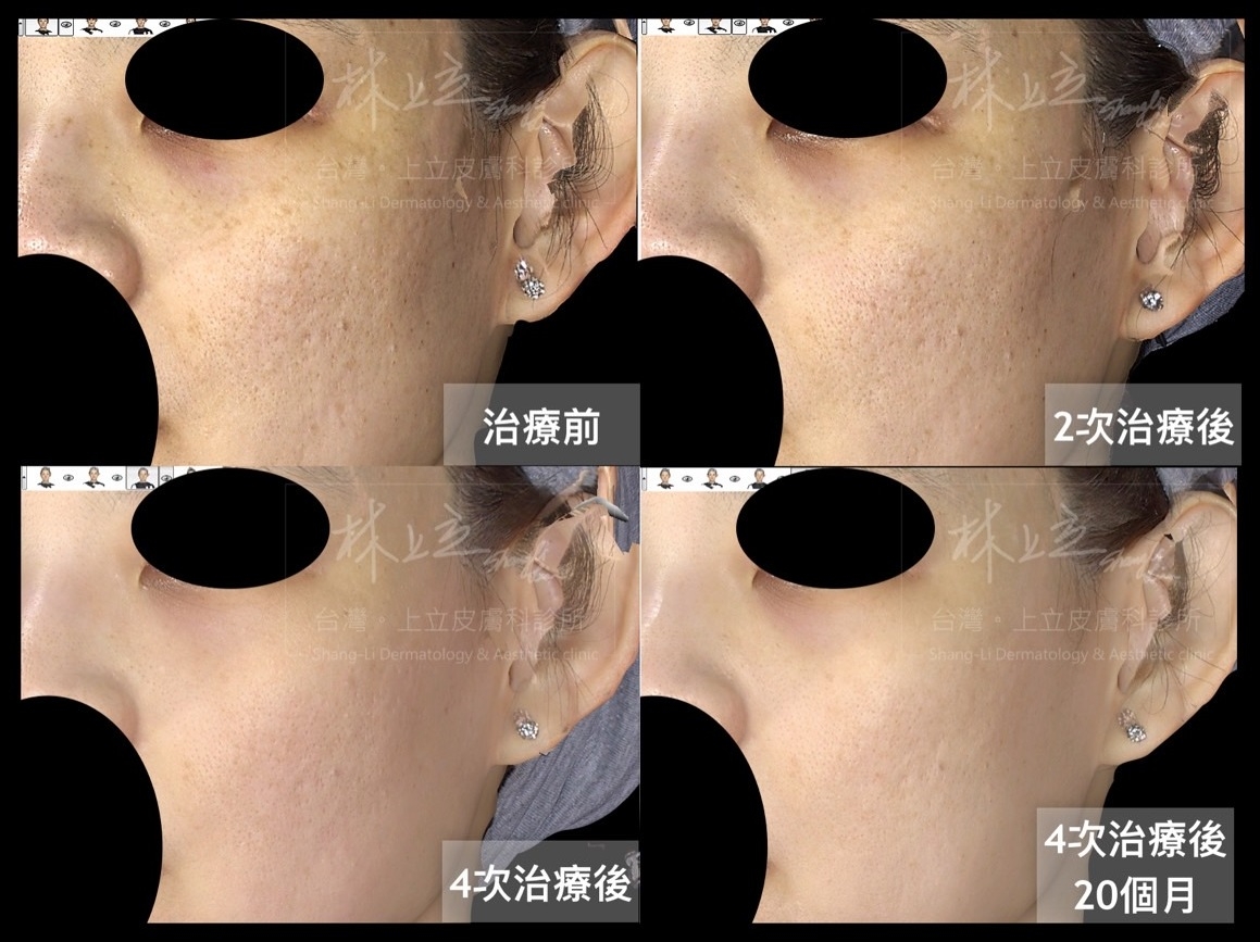 理細紋、毛孔的案例上，PicoSure755蜂巢皮秒雷射也有很好的改善效果。