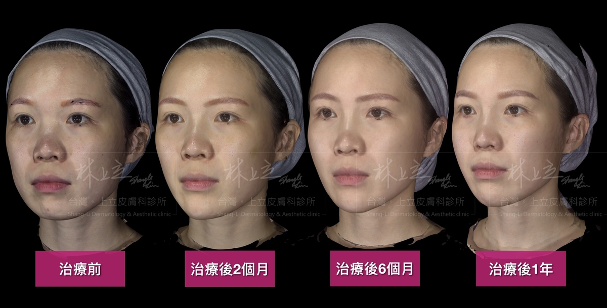 利用Aesthefill艾麗斯針對山根、顴骨、上顎骨等多個部位，分別加強它們的體積支撐