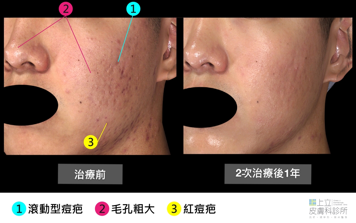 PicoSure755蜂巢皮秒雷射對於紅色痘疤也有很好的治療效果