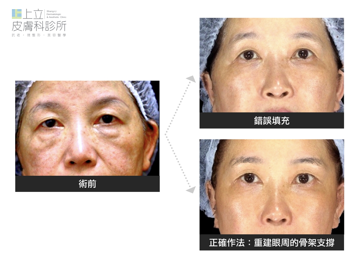 填充劑都不能直接打在淚溝上！錯誤填充既無法撫平淚溝，呈現效果也不自然