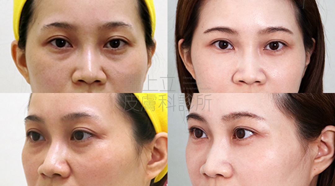 典型淚溝型黑眼圈的案例，不只眼下淚溝的溝紋清晰可見，眼周暗沈、黑眼圈的顏色也很深