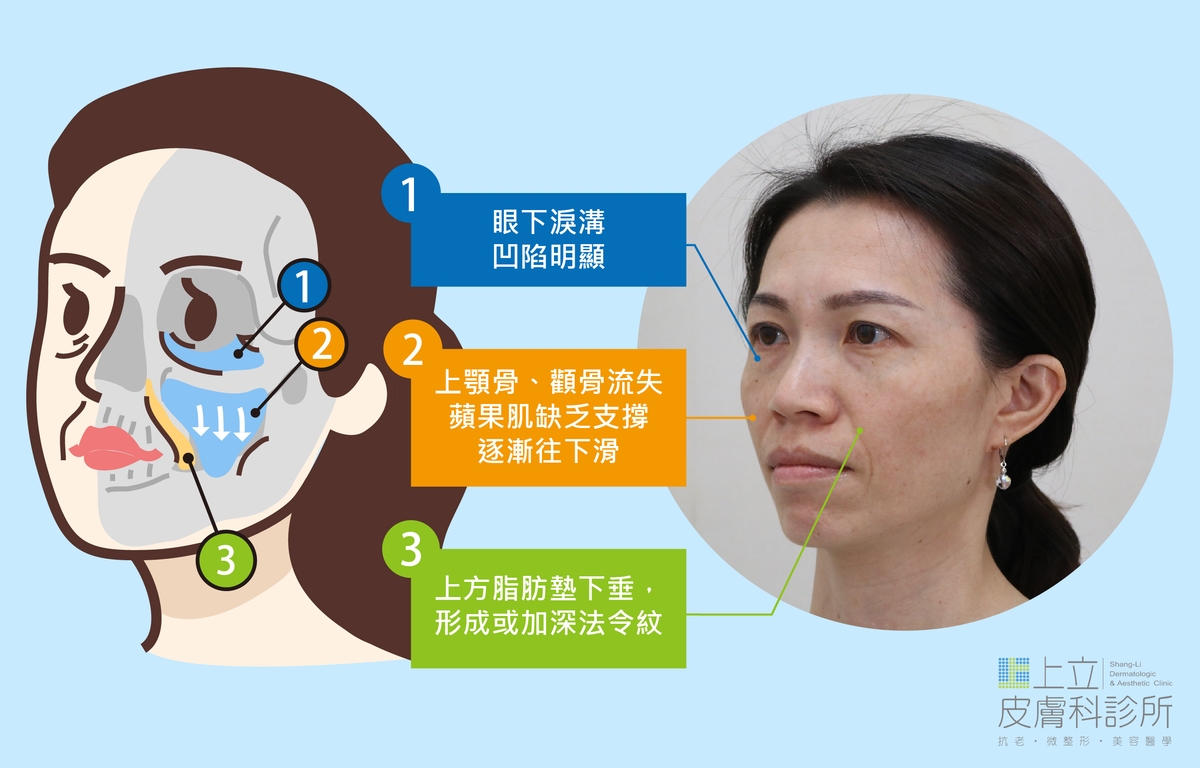 ELLANS&Eacute;洢蓮絲、AestheFill艾麗斯來重建眼周骨架支撐，把下滑的皮膚組織往上拉提，不只淚溝、結構性黑眼圈可以得到改善