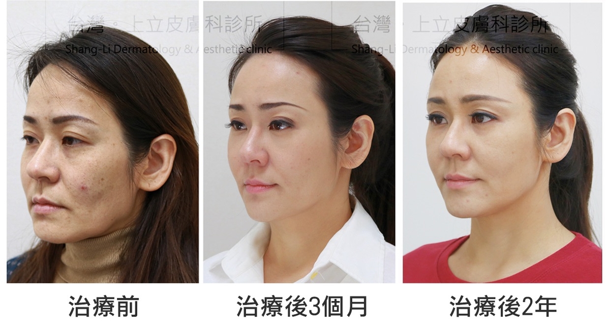 ELLANS&Eacute;洢蓮絲可以在治療當下就提供完整支撐