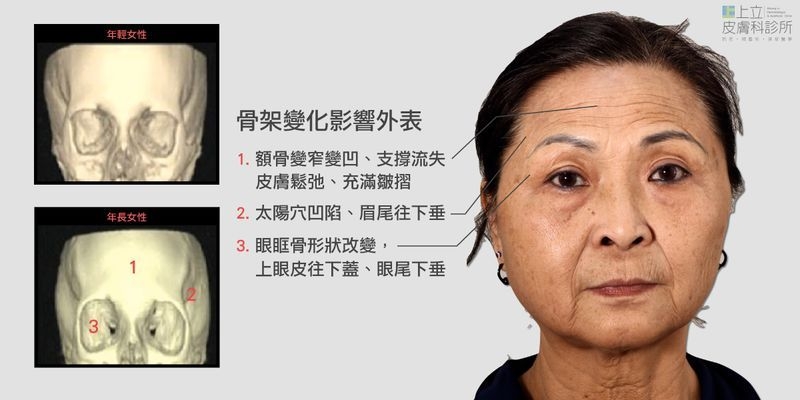 額頭充滿皺紋和凹陷，就連中臉和下臉部也會受到影響，導致眉眼、臉頰、下顎線等部位更往下垂，必須重建額頭和太陽穴的體積支撐才能改善。