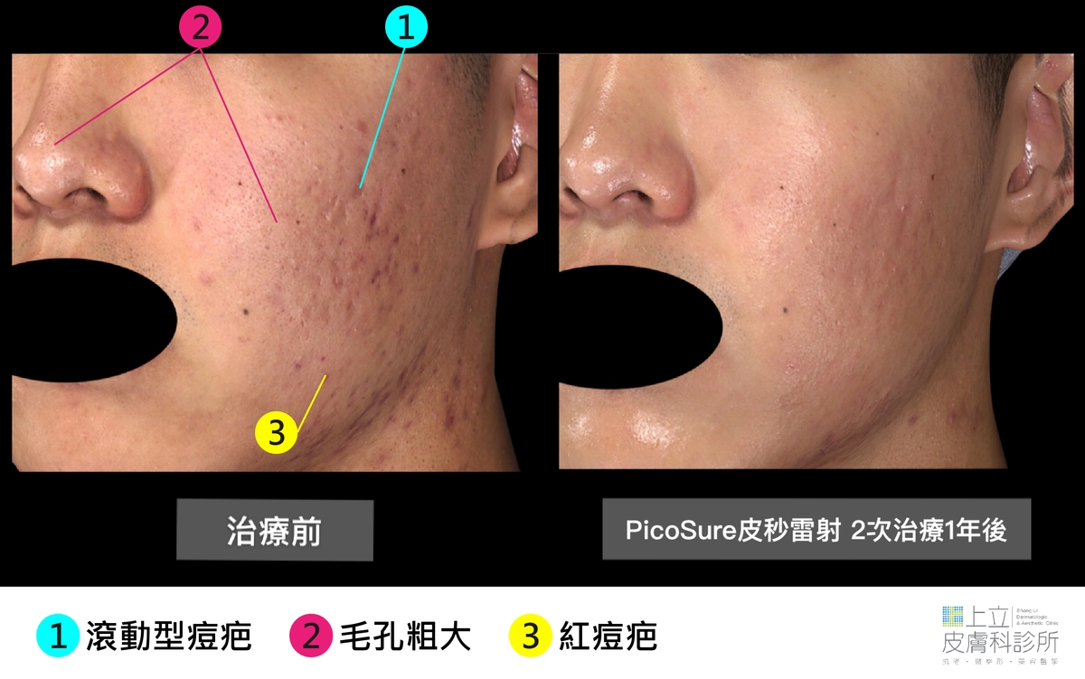 PicoSure755蜂巢皮秒雷射不只能刺激皮膚的淺層膠原蛋白新生，縮小毛孔