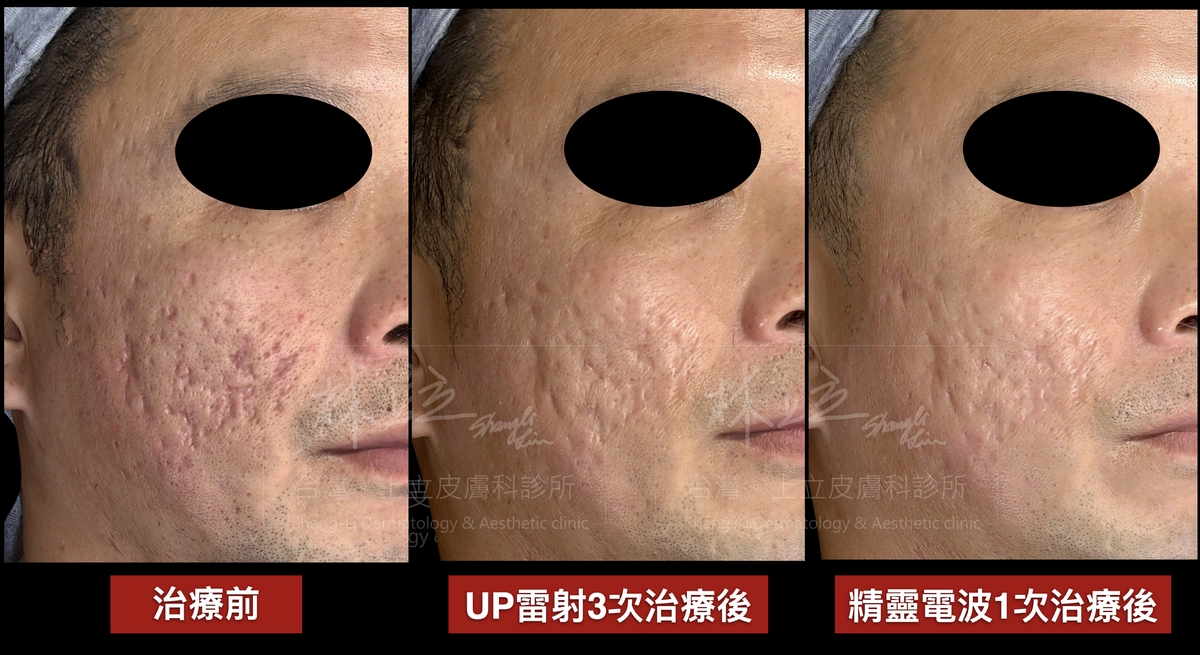 Genius精靈電波不只能有效改善紅痘疤
