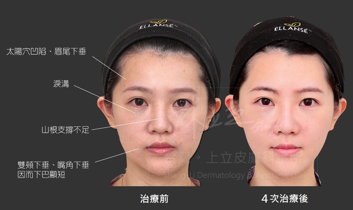 ELLANS&Eacute;洢蓮絲來治療之後，不只原先的淚溝、夫妻宮凹陷、眼尾和眉尾下垂的問題都改善了