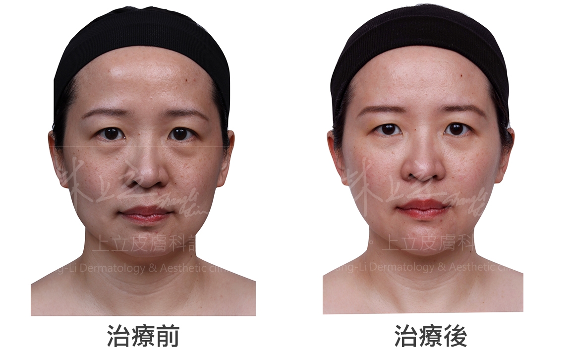 醫美界元老級的傳統填充物，玻尿酸用於重建深層體積的支撐、改善全臉老化症狀有不錯的治療效果