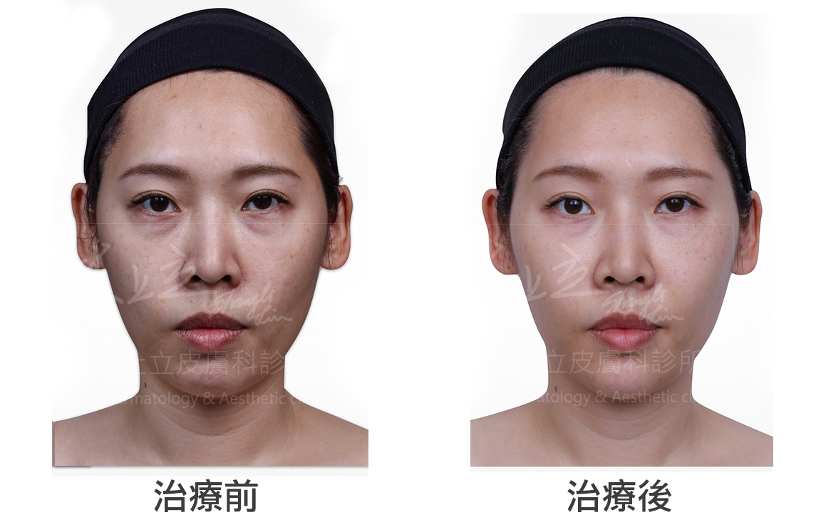 只要注射的手法正確，即使是淚溝也可以使用玻尿酸來改善