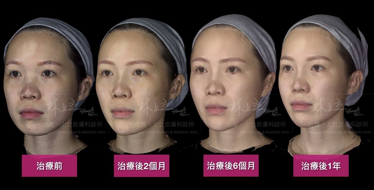 AestheFill艾麗斯的注射案例治療後2個月，整體狀態就有很明顯的進步了
