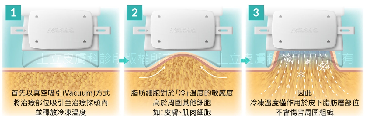 冷凍減脂原理一