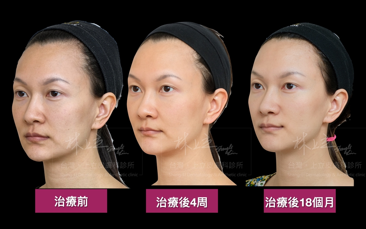洢蓮絲和艾麗斯合併治療，可以看見在治療之後，深層流失型法令紋和嘴邊肉都一起改善了