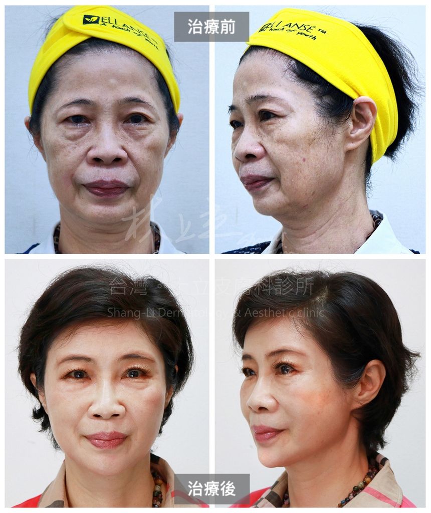 針對深淺層去做治療法令紋，可見在治療之後，不只淺層的法令紋摺痕有大幅度的改善