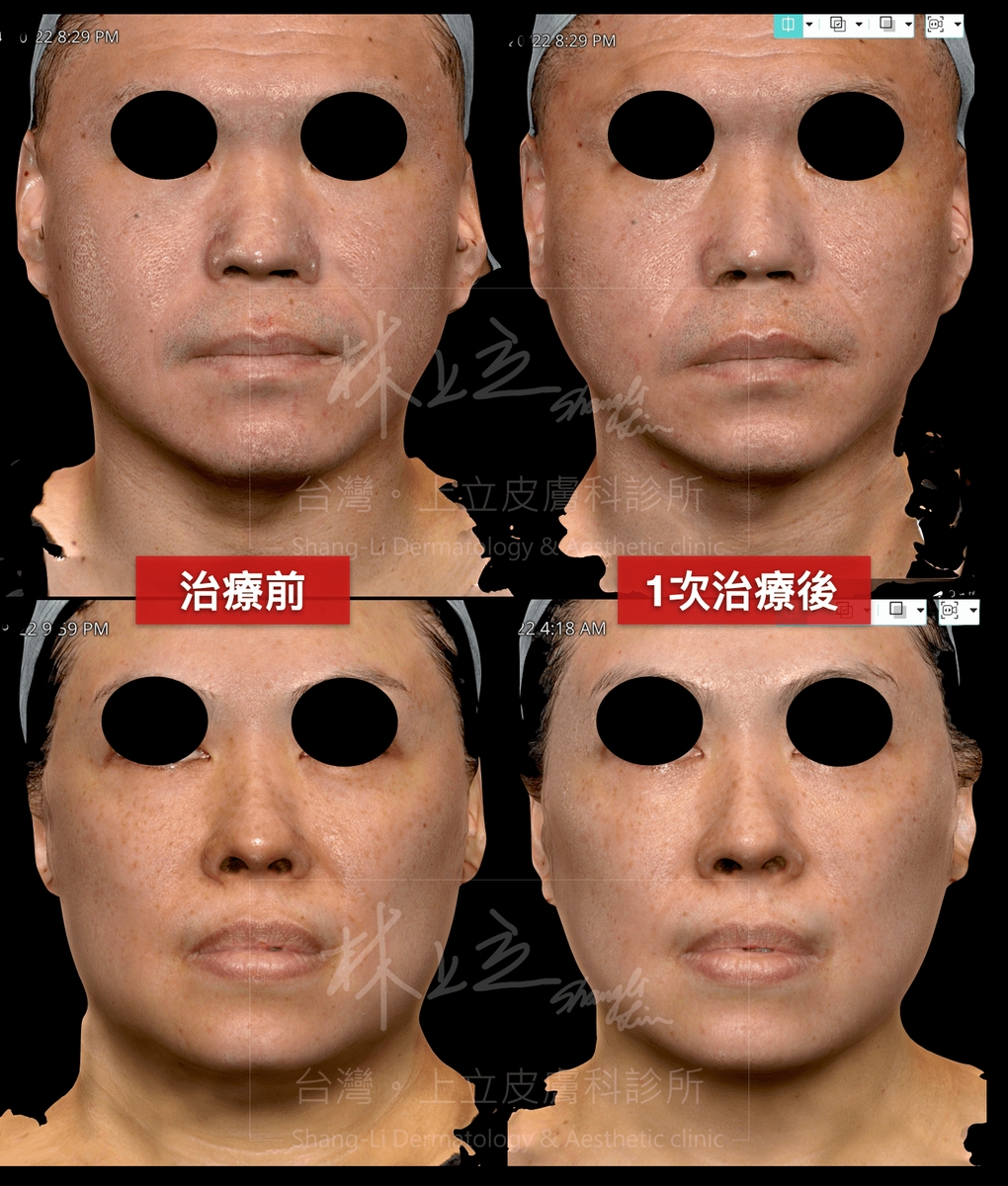 Genius精靈電波治療毛孔、斑點、皮膚泛紅等問題時，也能提供很好的緊實膚質效果