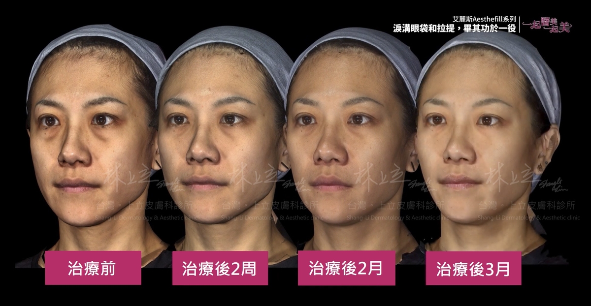 AestheFill艾麗斯在治療當下只會看見部分支撐效果，隨後膠原蛋白慢慢生長，效果才會逐漸完整起來