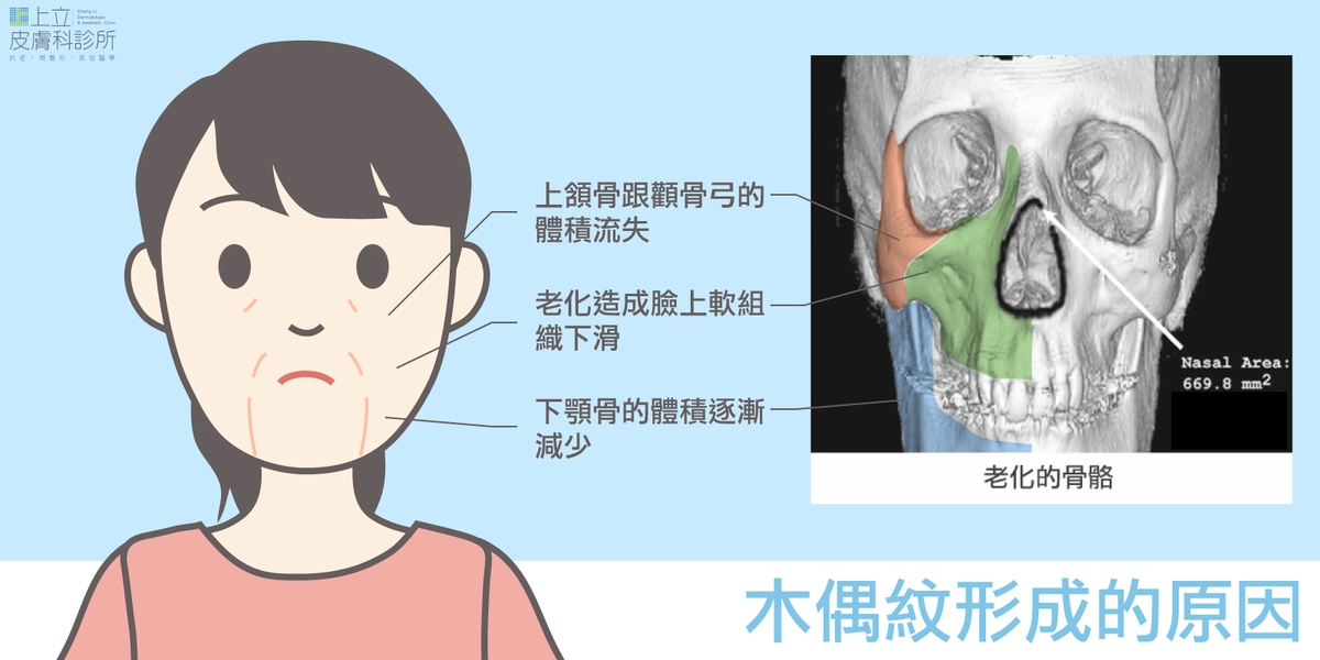 木偶紋形成的原因，失去支撐功能，產生肥厚的嘴邊肉和木偶紋。