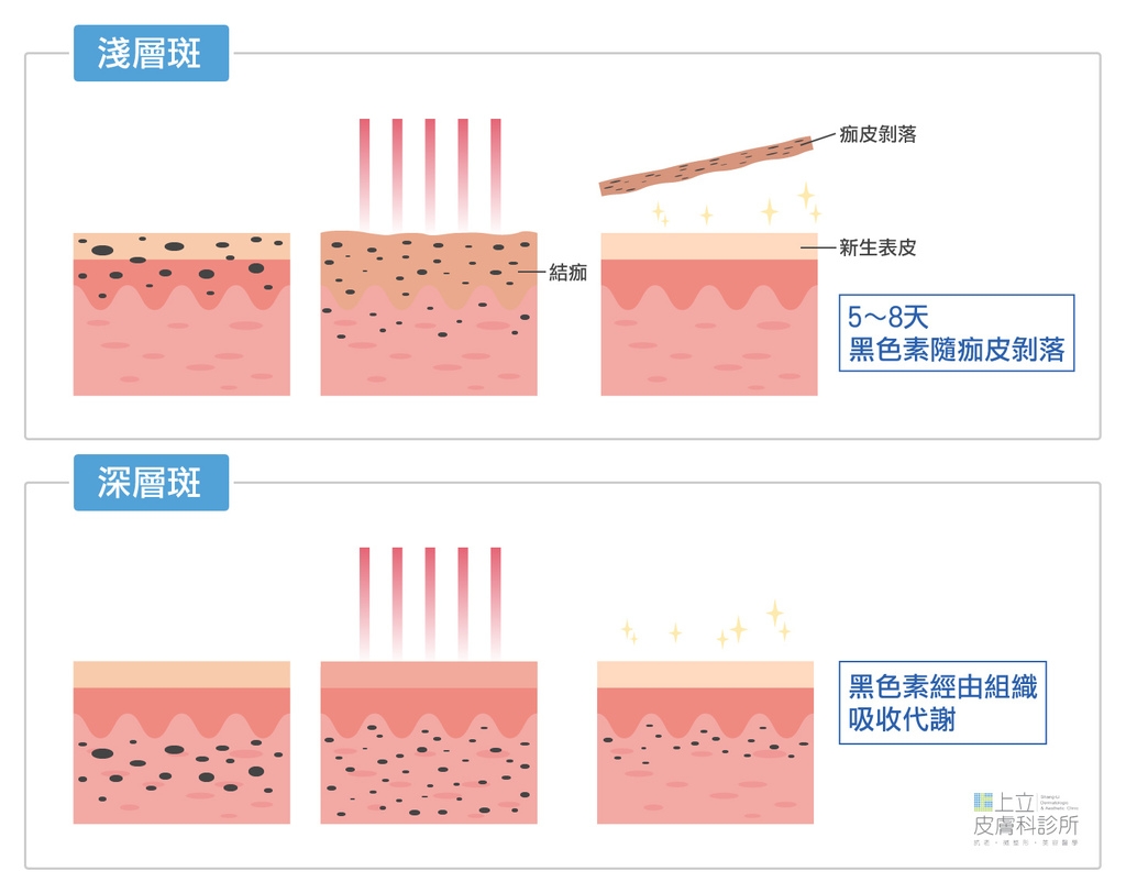 淺層斑的黑色素會經由表皮代謝、剝落