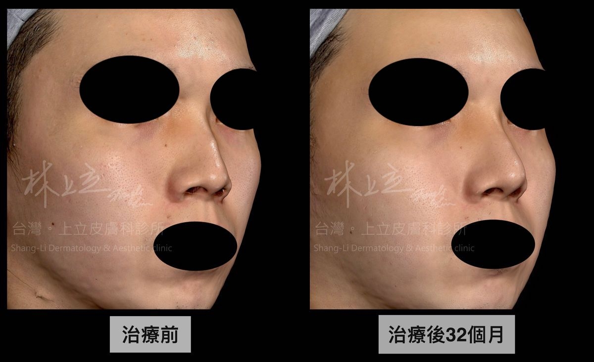 ELLANS&Eacute;洢蓮絲治療後32個月案例