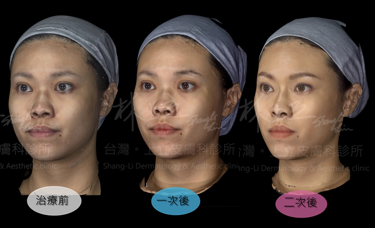 ELLANS&Eacute;洢蓮絲漸進式的治療手法，把整體療程分成二個階段