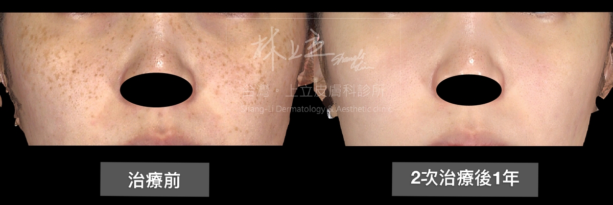 雀斑接受２次PicoSure755蜂巢皮秒雷射治療之後，原本佈滿雙頰的雀斑都被清除乾淨了，就連膚質的細緻度和光澤度都有所進步