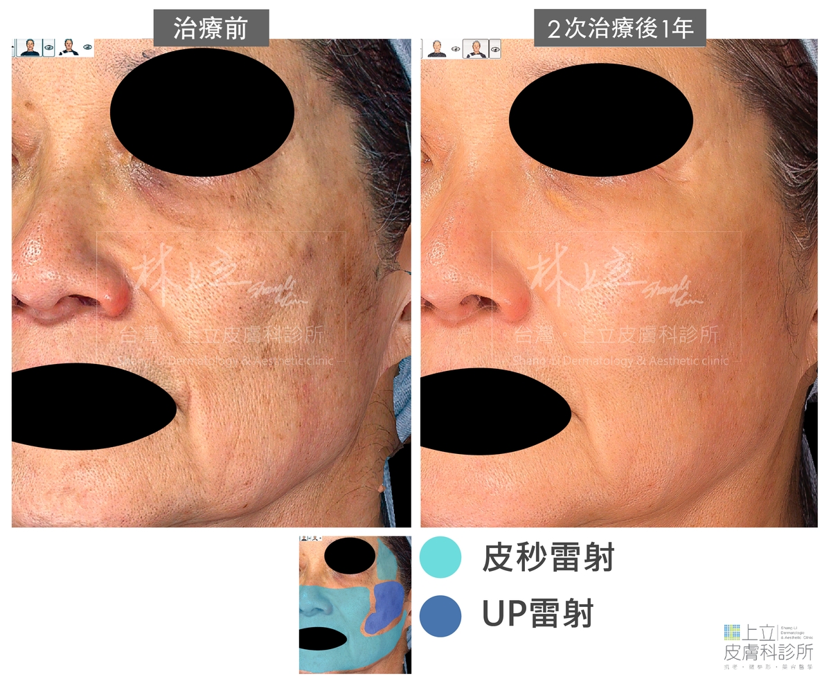 林上立醫師先以PicoSure755蜂巢皮秒雷射大面積掃除臉部暗沈並提升整體膚質，但針對部分區域使用UP雷射加快膚質改善的速度
