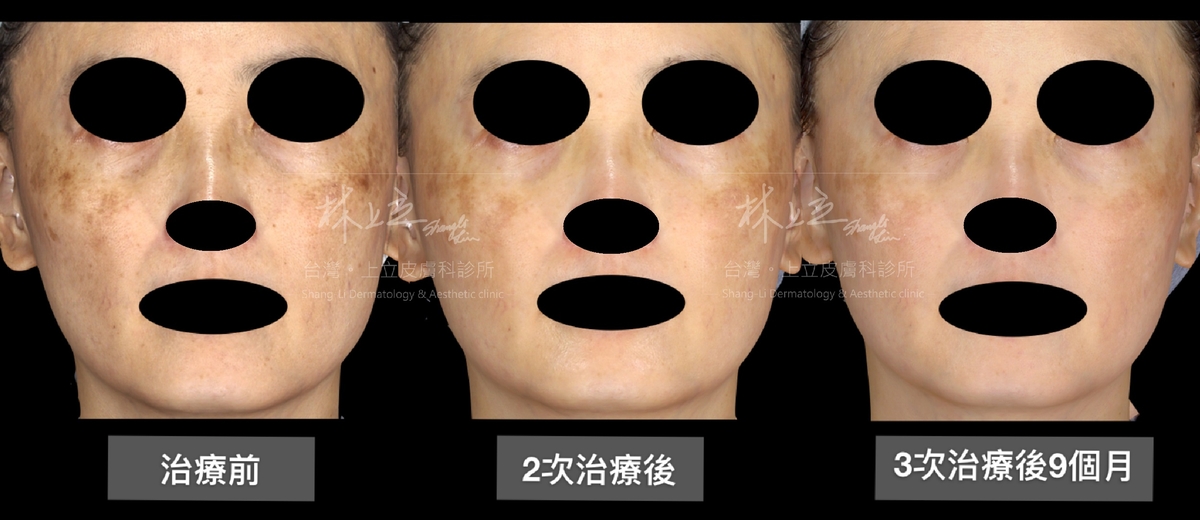 PicoSure755蜂巢皮秒雷射可以改善皮膚的光老化現象，可以有要改善並穩定肝斑膚質