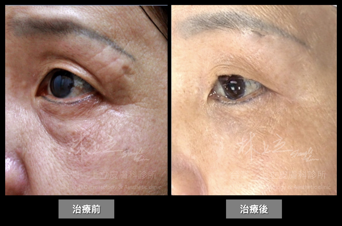 老化流失不只會導致淚溝、眼窩凹陷，也會改變眉毛和眼睛的形狀
