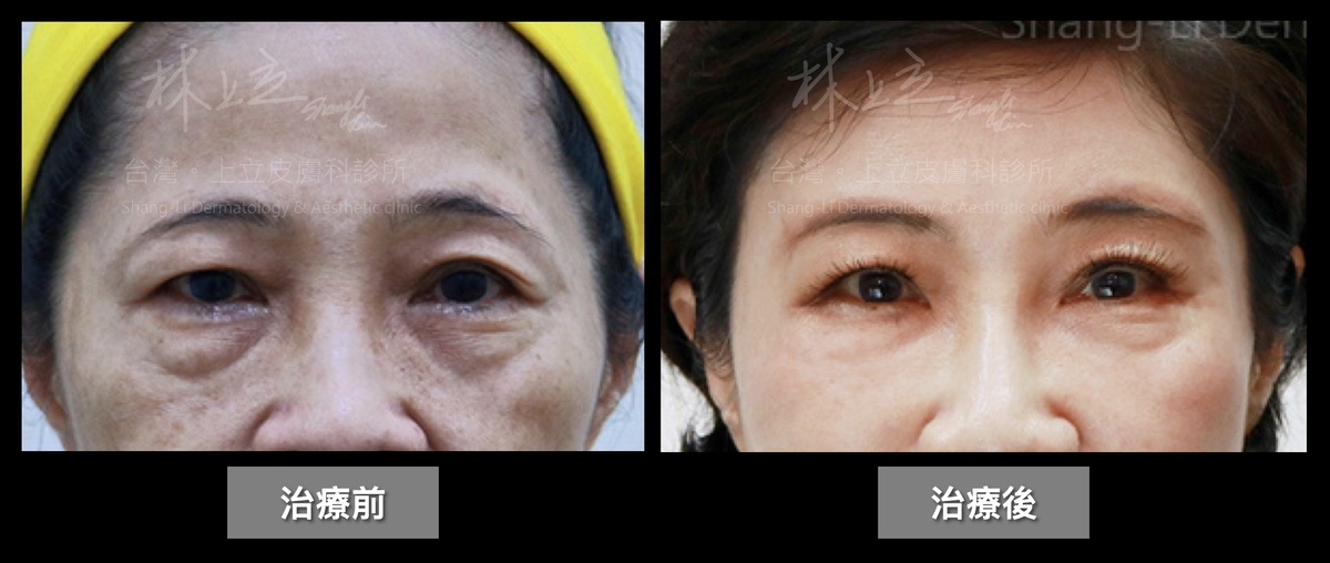 因為眼皮鬆弛下垂而「消失」的雙眼皮，也因而重現風采