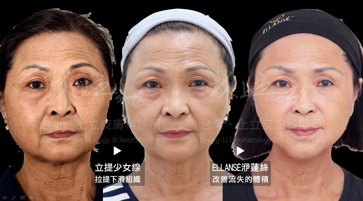 洢蓮絲重建深層脂肪和骨架的體積支撐，不只能有效解決嘴邊肉，就連臉部其他老化凹陷和紋路也有很大改善。