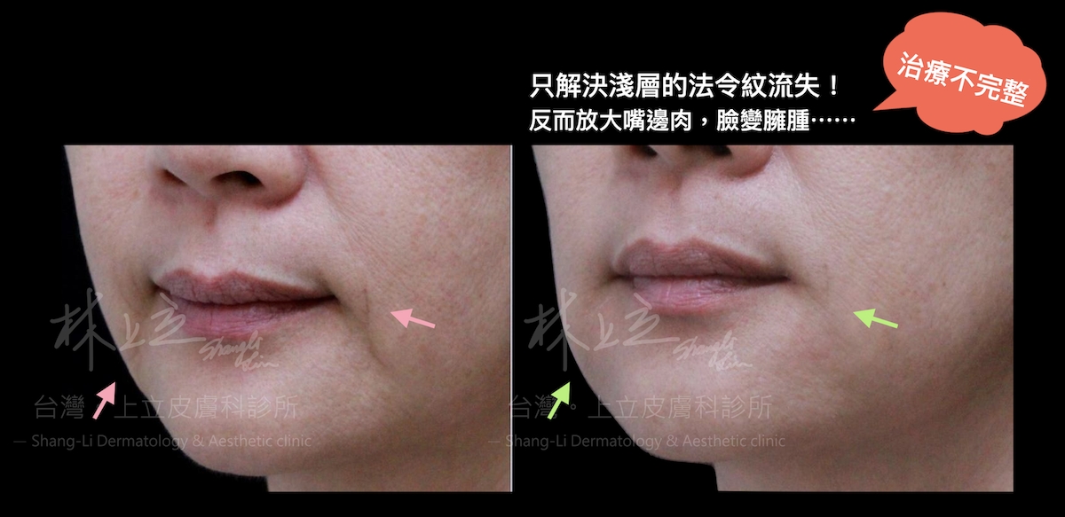 嘴邊肉的出現包含了深層和淺層的問題，如果只是把注射材質填補在淺層皮膚組織，底層的支撐一樣不穩
