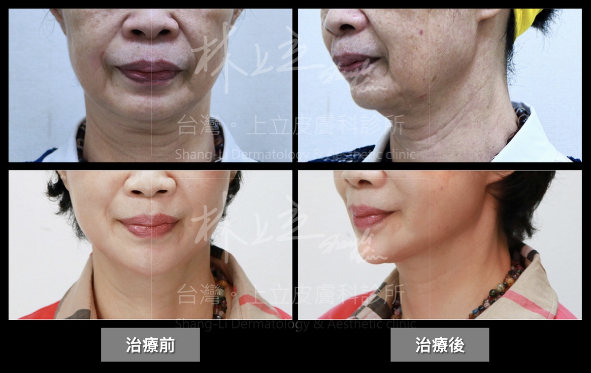 中下臉嘴邊肉多處都已有明顯的體積凹陷和紋路，所以林上立醫師針對這些部位分配恰當的注射劑量和深度