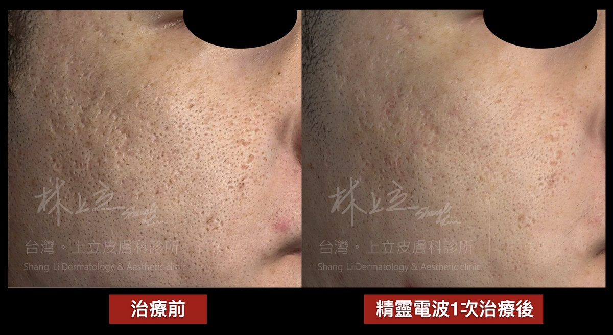 上立醫師在使用Genius精靈電波治療時發現，比起傳統痘疤雷射有更靈活的治療深度，一次兼顧深層和淺層痘疤的治療改善。