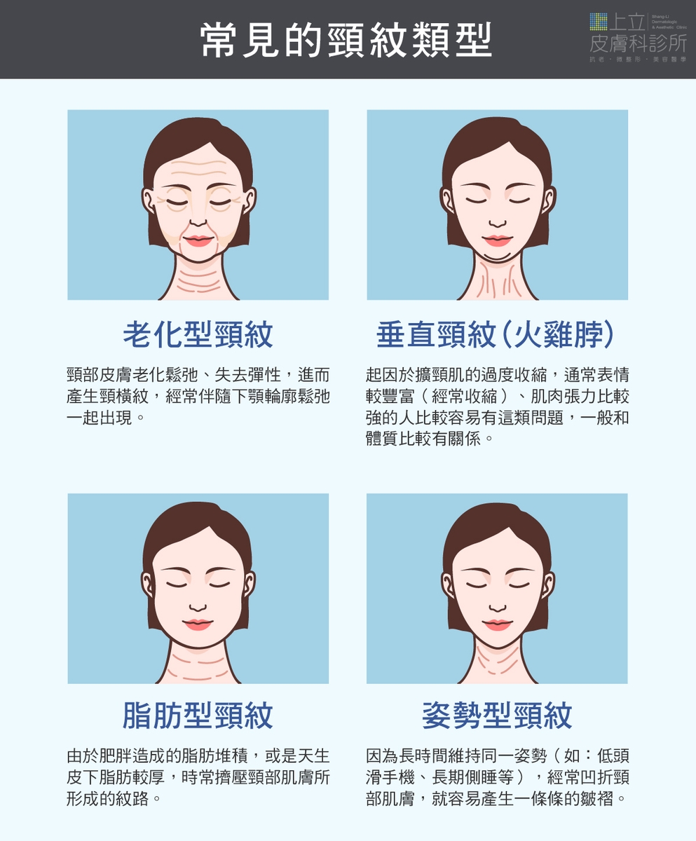 老化型頸紋、垂直頸紋、脂肪型頸紋、姿勢型頸紋類型比較
