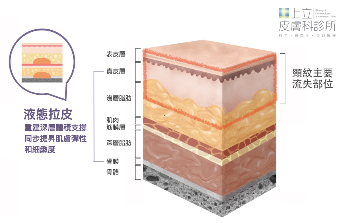 液態拉皮與頸紋主要流失部位關係