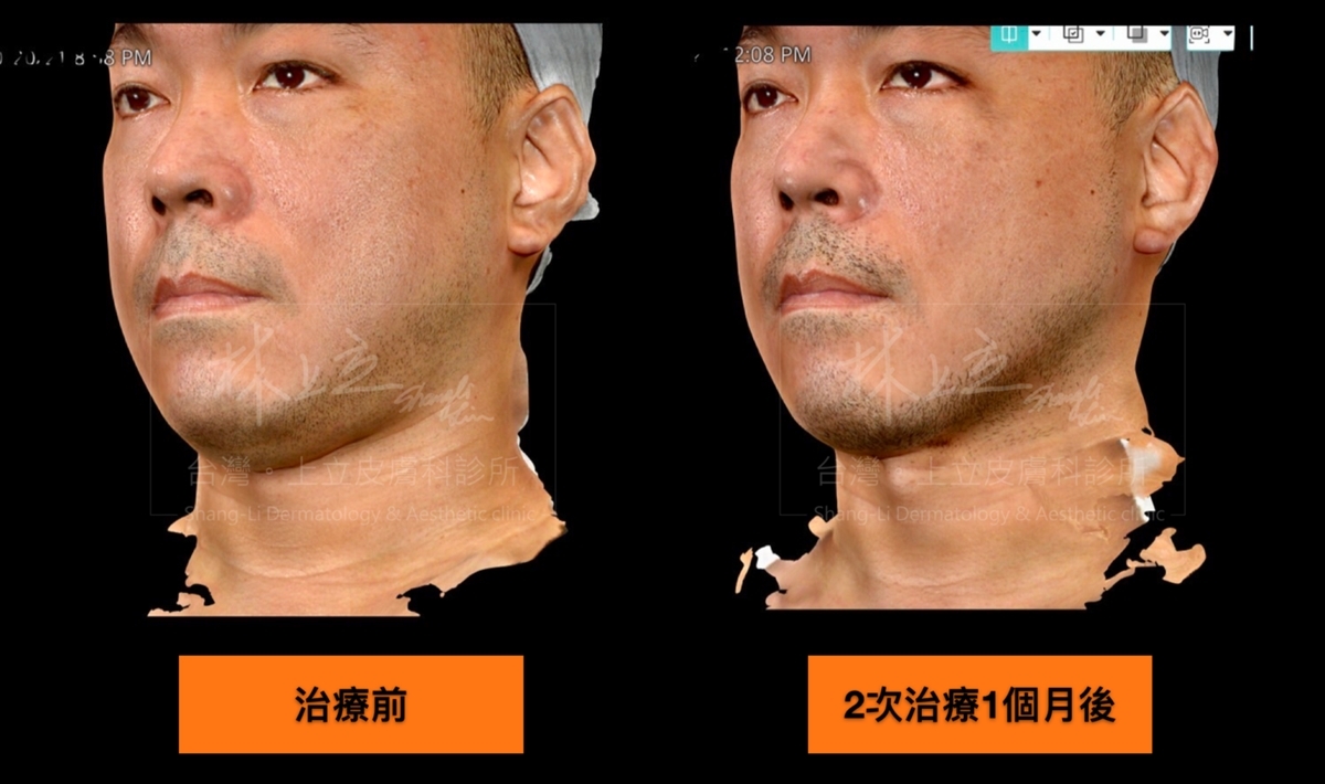 SculpSure熱塑溶脂只要單次治療，就可以明顯減少雙下巴的脂肪