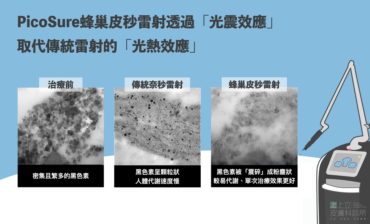 PicoSure755蜂巢皮秒雷射可以將黑色素顆粒震碎形成粉末狀，更容易被皮膚代謝