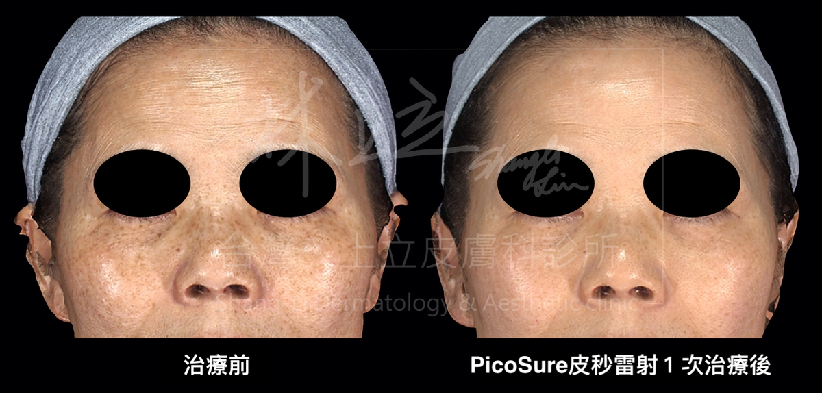 PicoSure蜂巢皮秒雷射在淡化斑點、色素沉澱的問題時，連同細紋、毛孔、膚質平滑度都有很大改善。