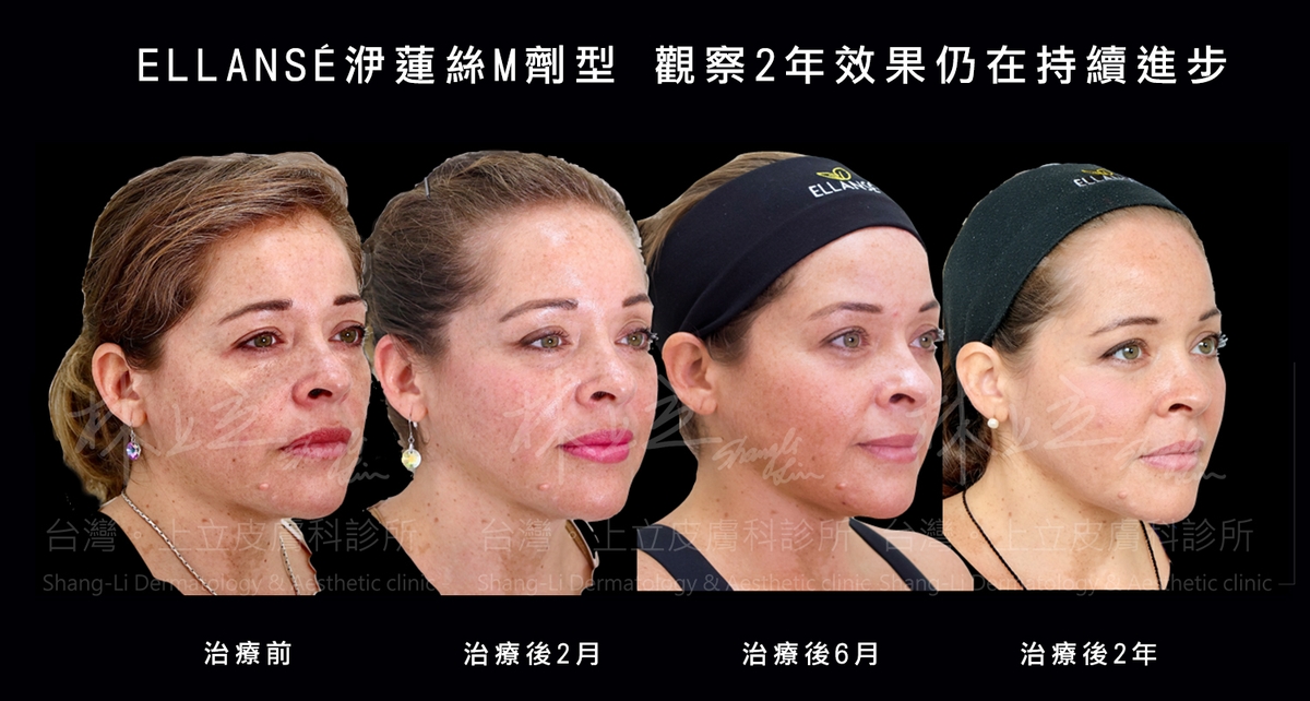 洢蓮絲Ｍ劑型的的PCL晶球鍊比較長，可以延長刺激膠原蛋白生長的時間