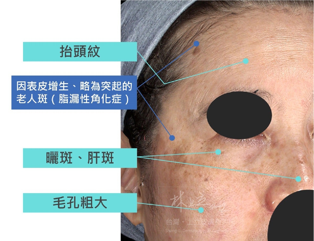 臉部往往不會只有一種斑點問題，甚至還會合併紋路、毛孔粗大、膚色暗沈等狀況一起出現