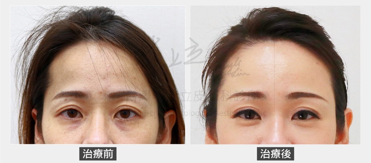 林上立醫師使用ELLANSE洢蓮絲改善眼窩凹陷