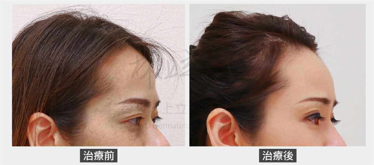 林上立醫師使用ELLANSE洢蓮絲去增加額頭與眼周的深層體積支撐，額頭恢復年輕飽滿度