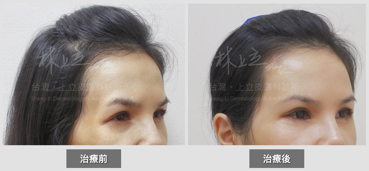 ELLANSE洢蓮絲是採取凝膠劑型，PCL晶球均勻懸浮於治療部位可以讓膠原蛋白的均勻生長