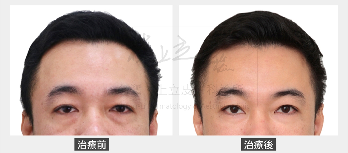 林上立醫師先是利用ELLANSE洢蓮絲增加額頭體積支撐，卻特別留意沒有將額頭打得太過飽滿
