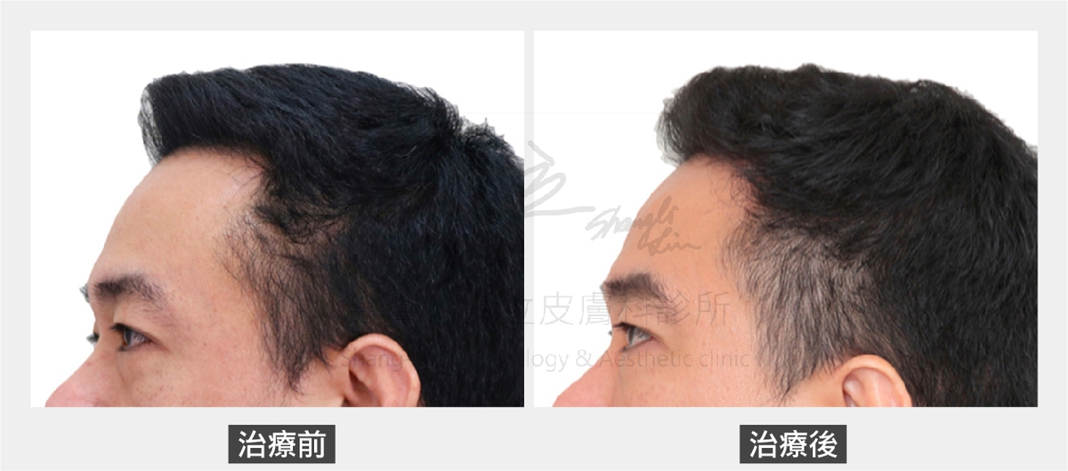 林上立醫師先是利用ELLANSE洢蓮絲增加額頭體積支撐，重建眼眶骨的支撐