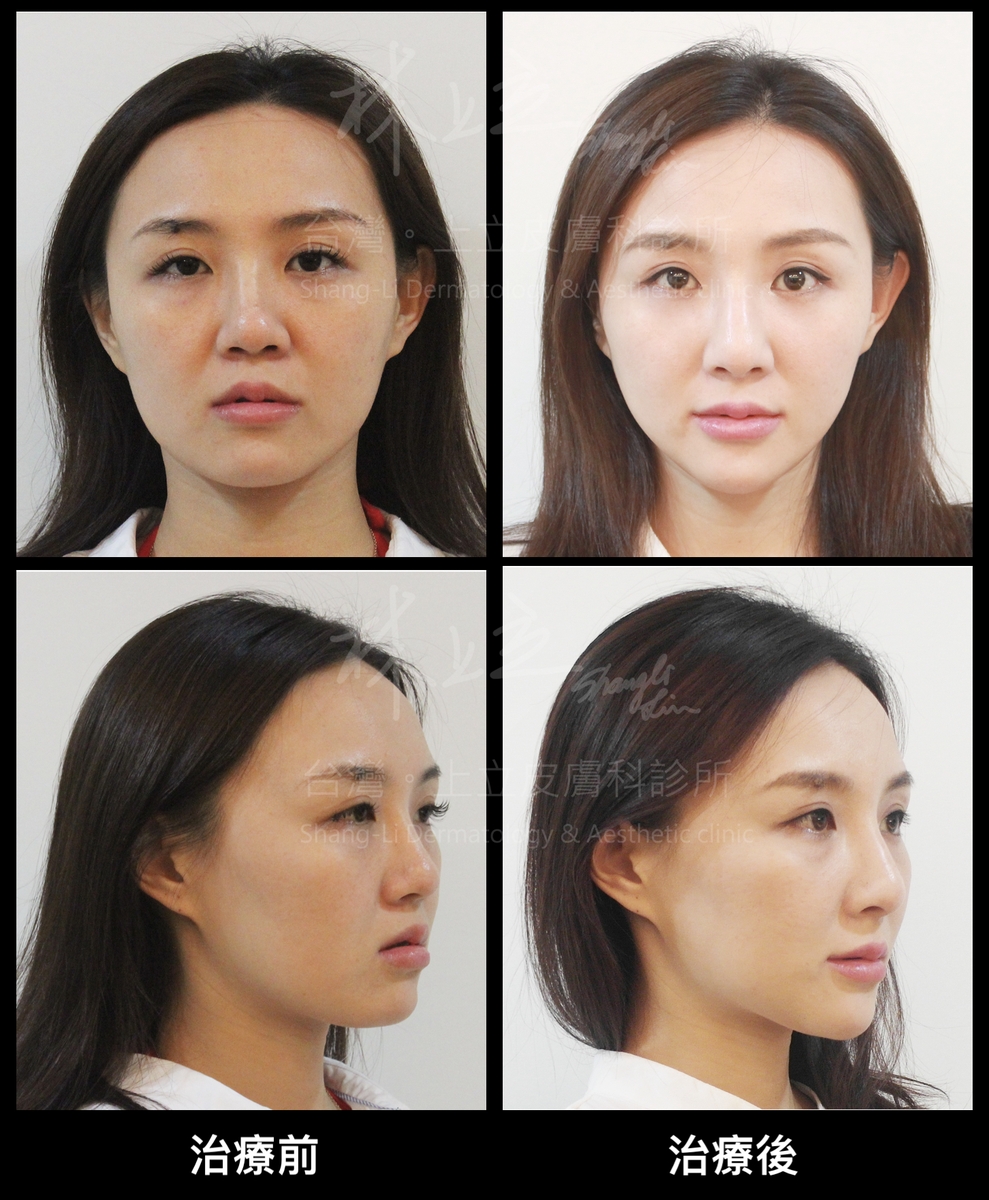林上立醫師特別針對中臉骨架去加強支撐，包含眼下、耳前、鼻基底等部位，有效改善淚溝和法令紋凹陷
