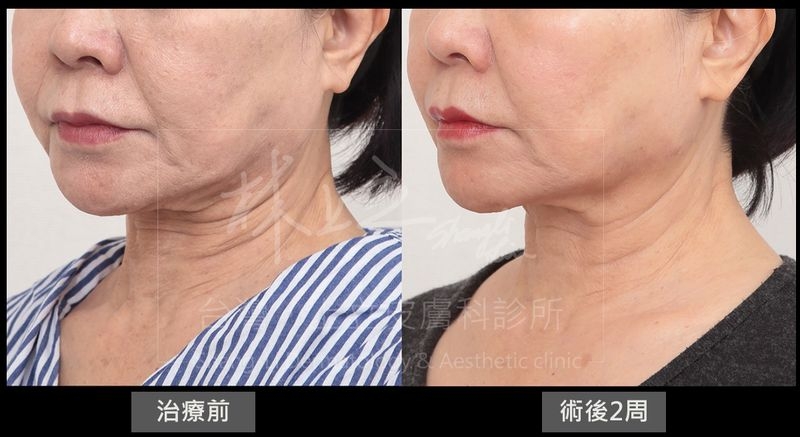 利用ELLANS&Eacute;洢蓮絲重建中下臉的骨架支撐後，不只有效解決嘴邊肉和雙下巴