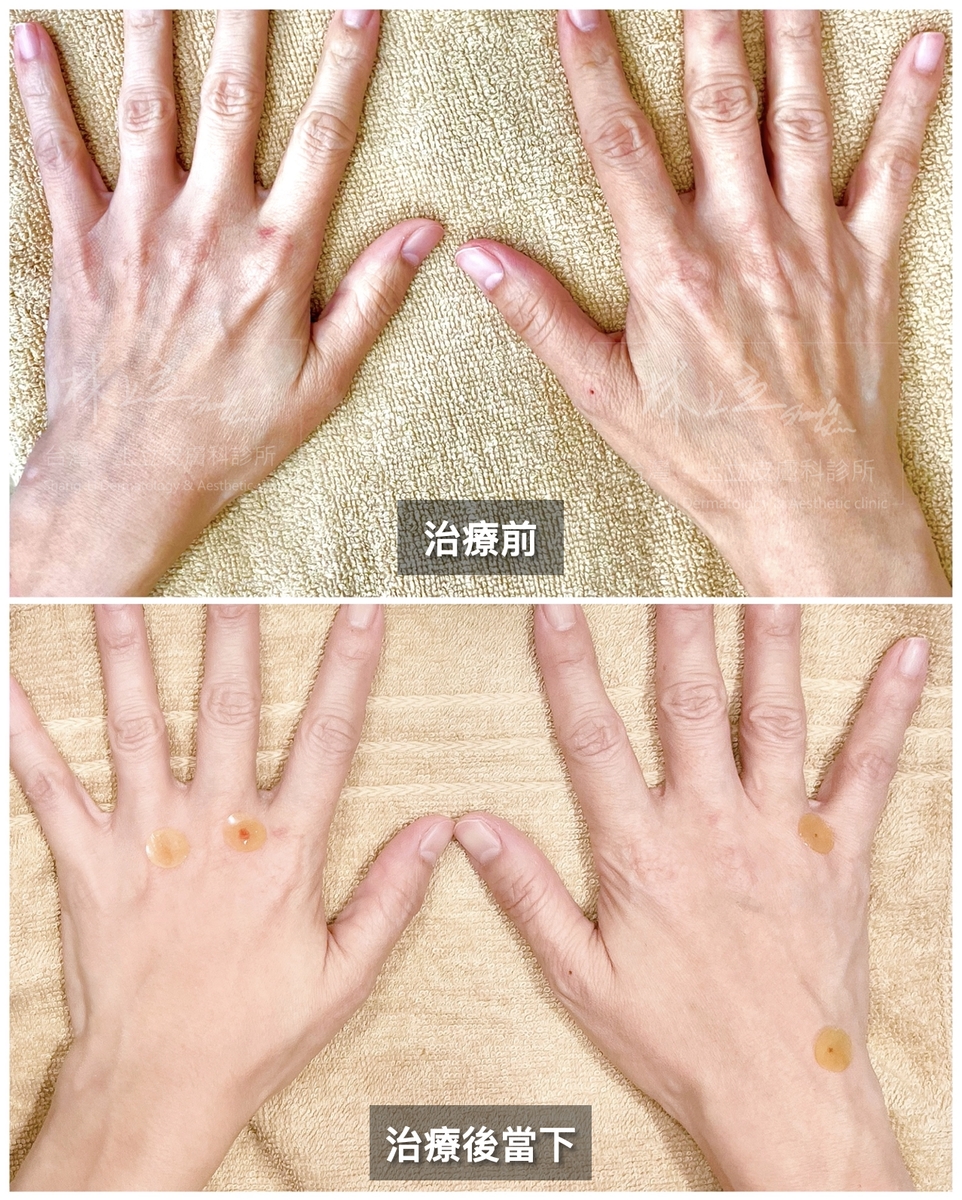 ELLANS&Eacute;洢蓮絲，快速恢復手部肌膚的豐盈感，改善原先指節凸出、手臂乾癟
