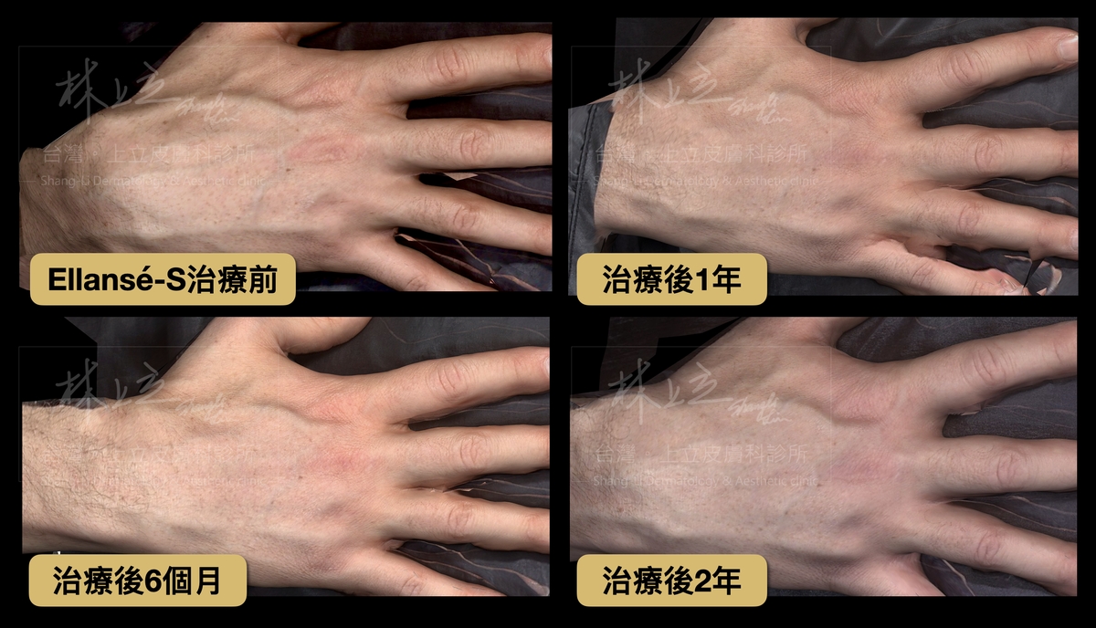 ELLANS&Eacute;洢蓮絲可以刺激手部肌膚，不會因為手部動作被快速流失而失去治療效果