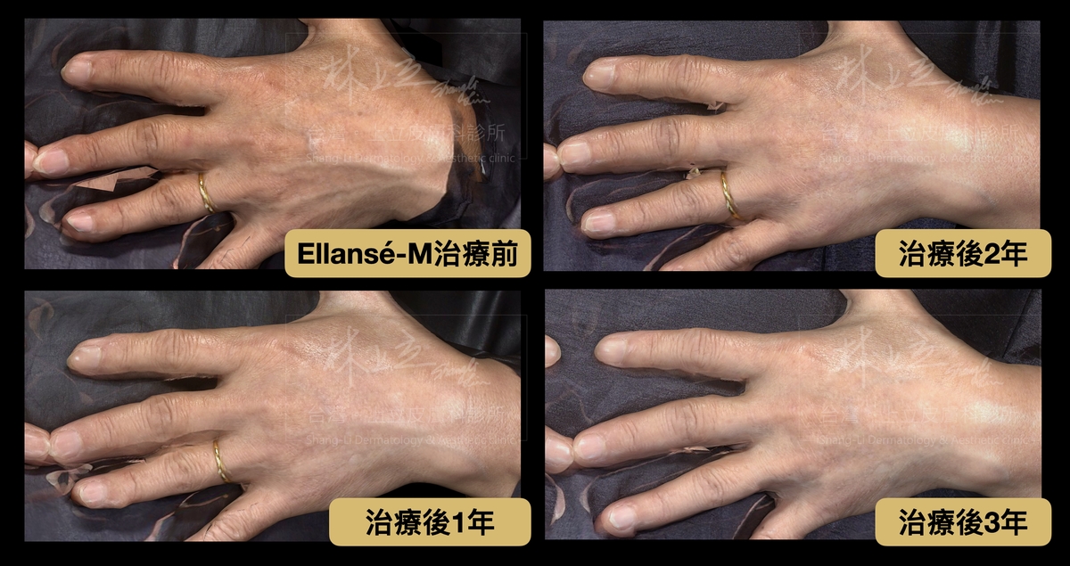 注射ELLANS&Eacute;洢蓮絲Ｍ劑型，可見在治療後2年內，手部膚質狀態還在不斷進步