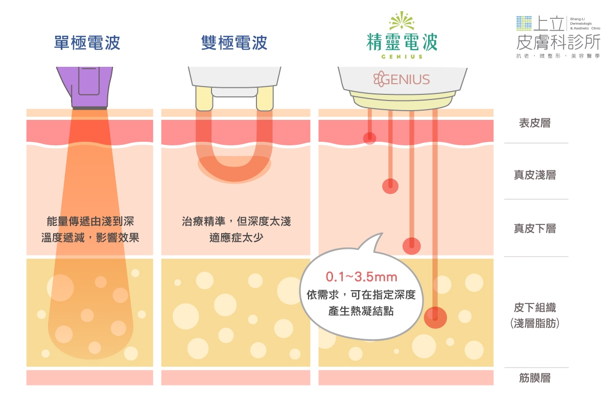 Genius精靈電波，就保留了雙極電波的精細治療、淺層治療特性，加入單極電波深層治療的能力，融合兩者優點